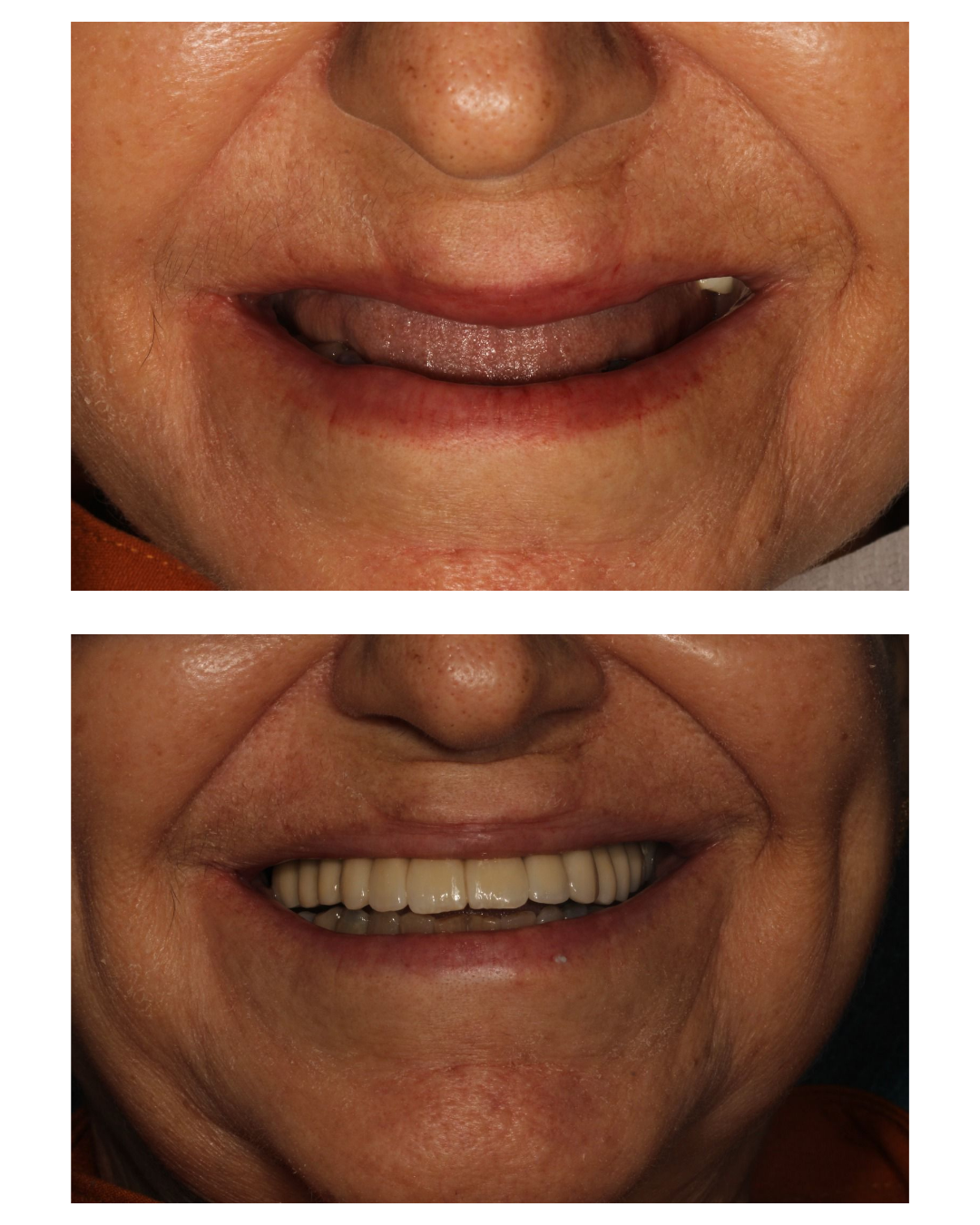 Antes e depois de tratamento com implantes dentários — Dra. Ana Valéria Cruz, CRO-CE 2897
